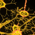 Neuroprotección en Esclerosis Múltiple progresiva primaria con la amilorida