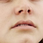 Espasticidad facial en Esclerosis Múltiple y otras patologías neurológicas